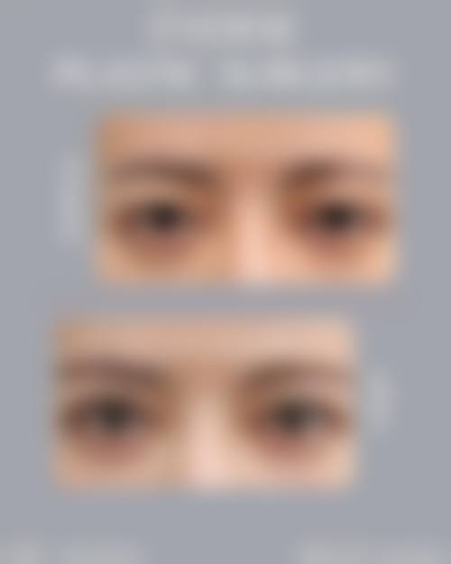 {割双眼皮能不能同房呢？术后1周内不建议，1个月后眼部稳定可逐步恢复正常生活 