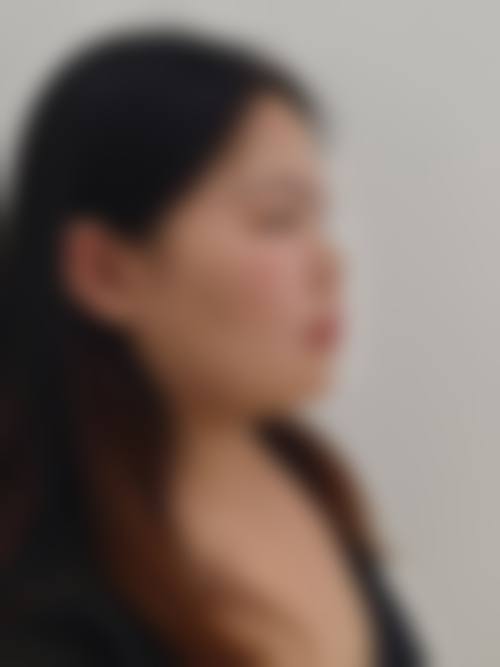 蛋白线提升隆鼻之自身情况结合