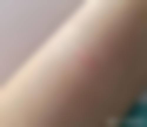 疤痕增生破皮后促进愈合的方法