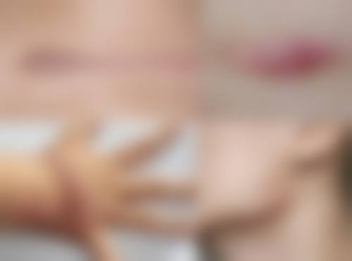 疤痕增生破皮后不愈合的原因