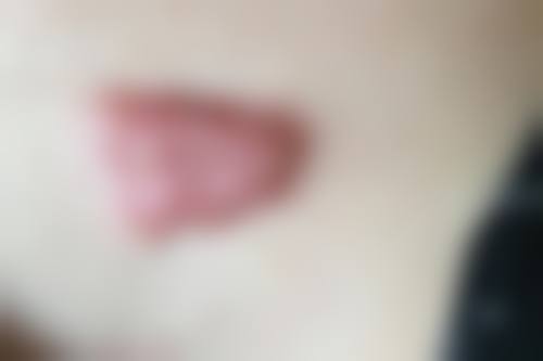 {疤痕增生破皮后还能愈合吗？与个人体质、损伤程度有关，正确处理多数可恢复 