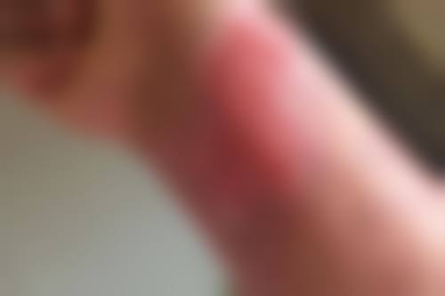 疤痕增生破皮后愈合的注意事项
