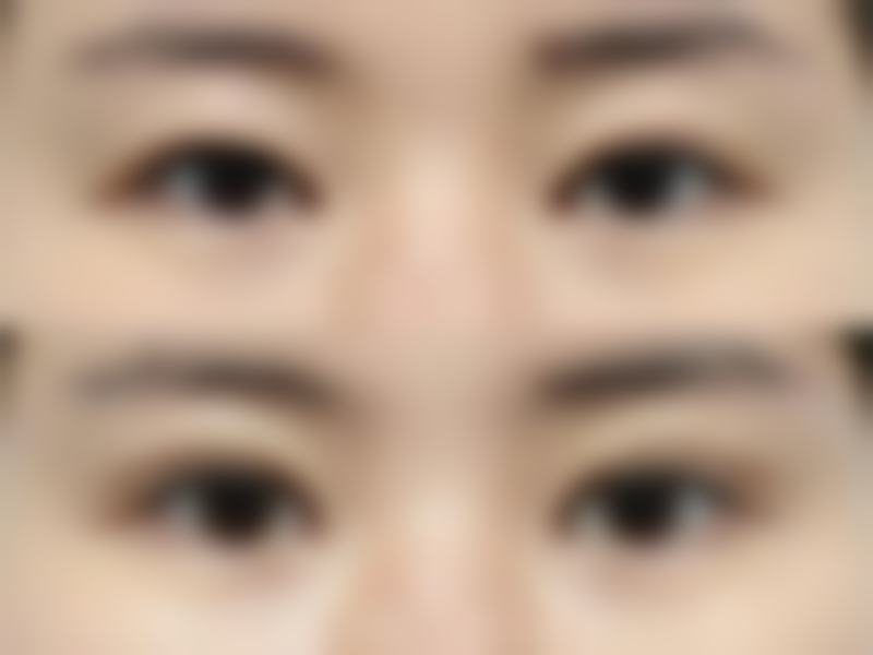年龄增长对全切双眼皮持久性的影响