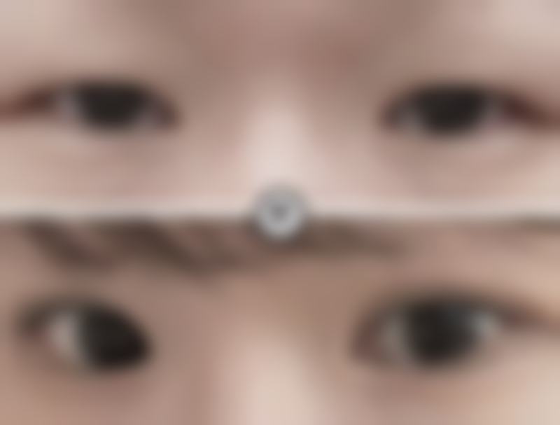影响全切双眼皮持久性的个人体质因素