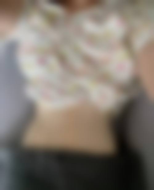 手臂吸脂修复各阶段的表现
