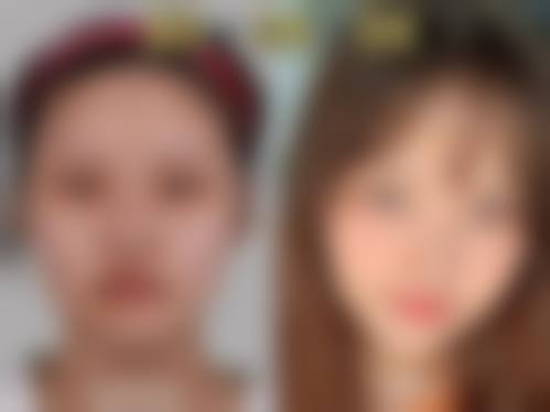 开眼角和开双眼皮价格选择建议