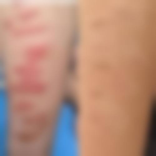 {脸上破皮怎么不留疤痕？做好伤口消毒、补充营养及用表皮生长因子可降低留疤率