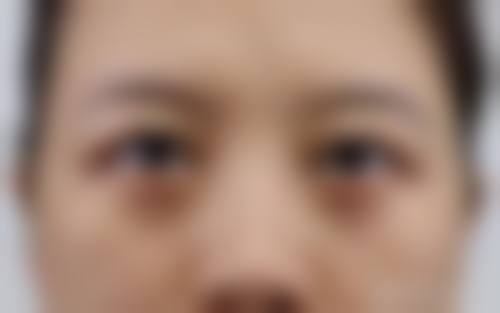 溶脂祛眼袋的劣势与成效影响