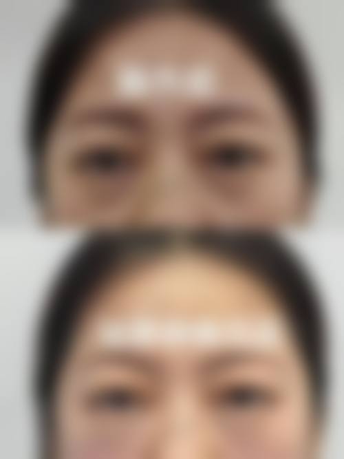 溶脂祛眼袋的注意事项与成效保护
