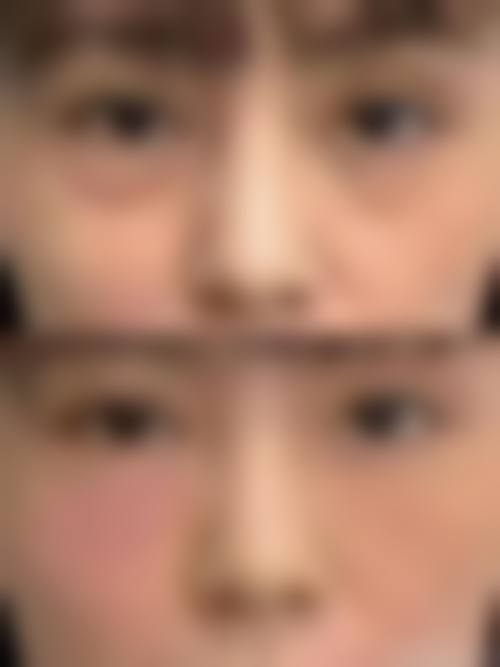 溶脂祛眼袋的优势与成效体现