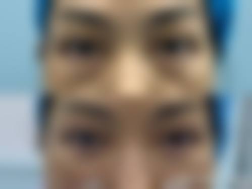 溶脂祛眼袋的适用人群与成效
