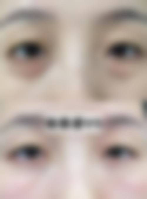 不同手术方式与眼袋挖多