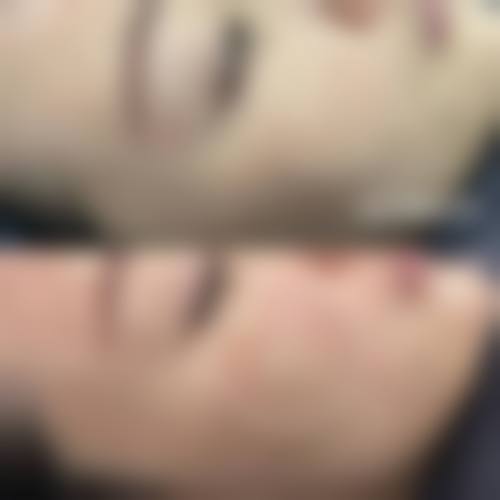 赠送嫩肤项目的价值