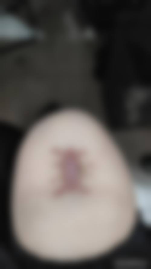 缝针的疤痕日常护理要点