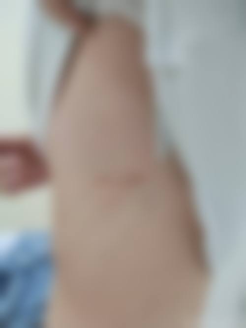 缝针的疤痕消除实例分享