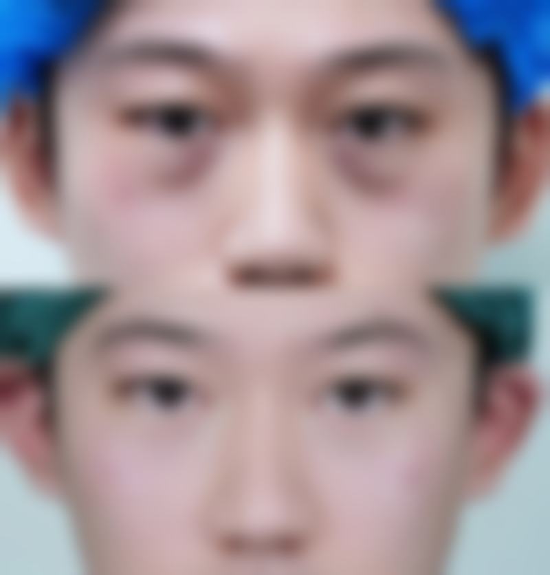 饮食调理助力眼袋挖多修复