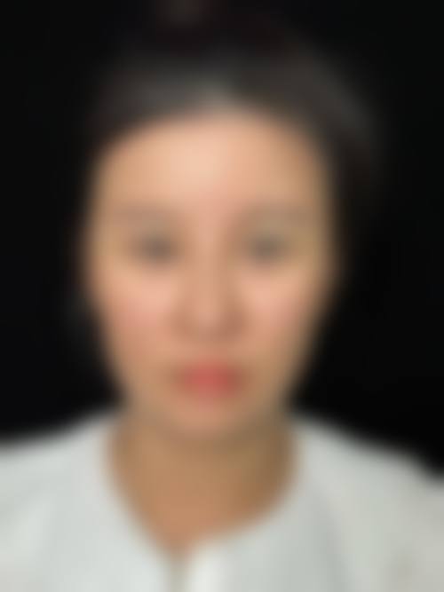 过敏问题造成眼皮肿