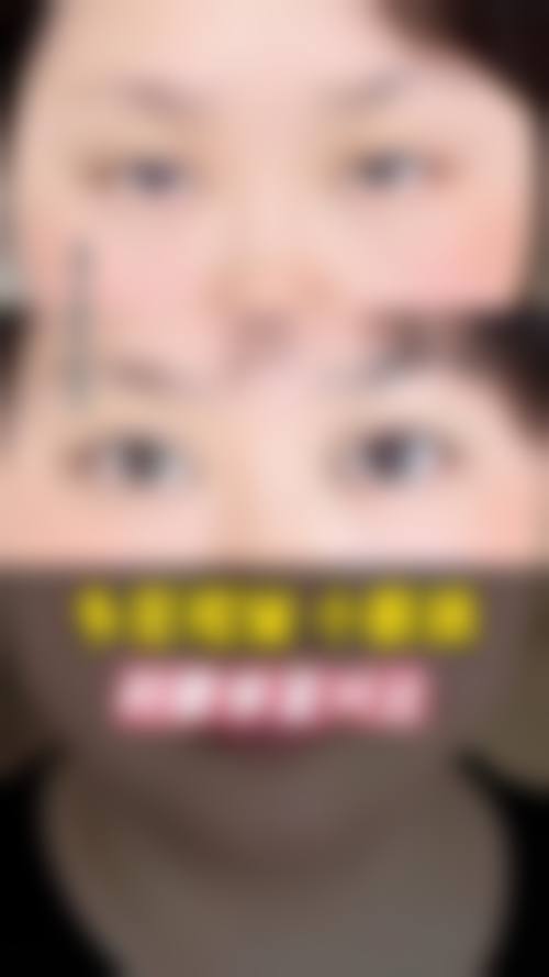 淋巴/静脉回流问题加重眼皮肿