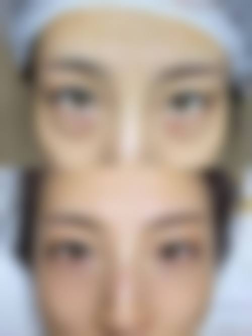 实例展示手术去眼袋成效
