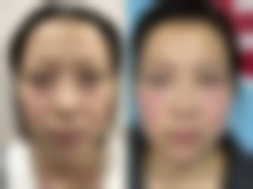 {手术去眼袋效果好不好？选对术式与医生，可实现眼袋消除、泪沟平整的自然年轻态