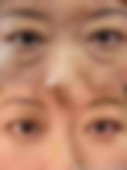 手术去眼袋成效的维持时间
