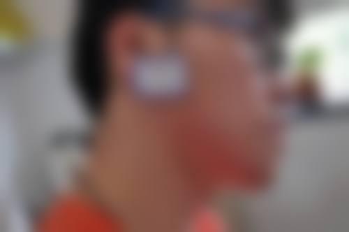 {怎样去除被烫疤痕？可根据疤痕类型选硅酮凝胶、激光或手术等修复方案