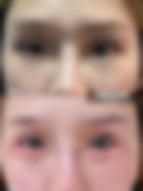 双眼皮修复之组织缺损危害