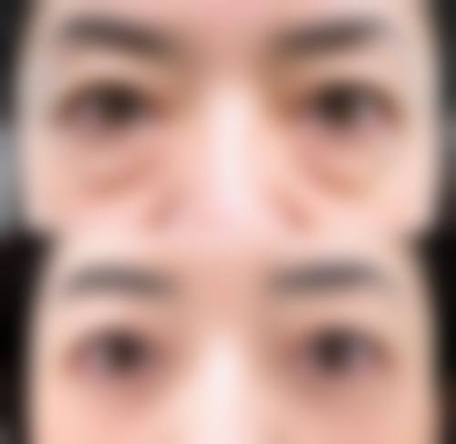 {隐形去眼袋是怎么做的视频？经结膜内路微小切口，吸除眶隔脂肪并提拉眼部皮肤