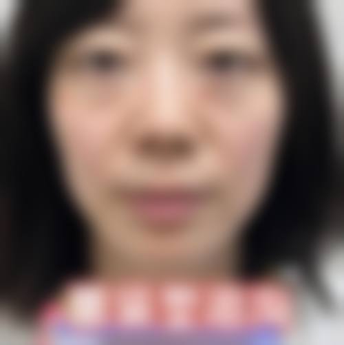 隐形去眼袋的优势体现