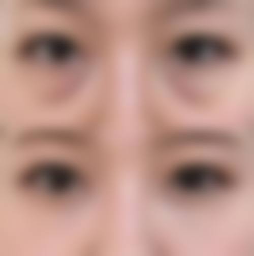 隐形去眼袋的手术过程