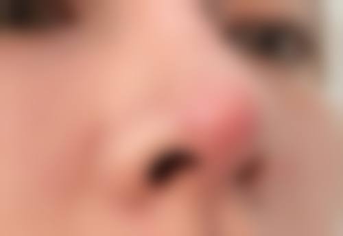 如何延长自体肋骨隆鼻的成效