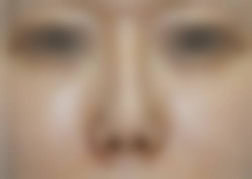 {自体肋骨隆鼻可以永久的吗？通常能长久维持，受体质、术后护理及医生技术影响
