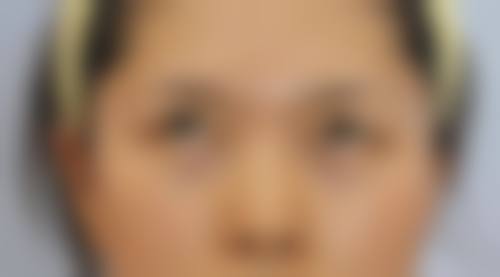 用鸡蛋滚眼睛对不同类型眼袋的成效分析