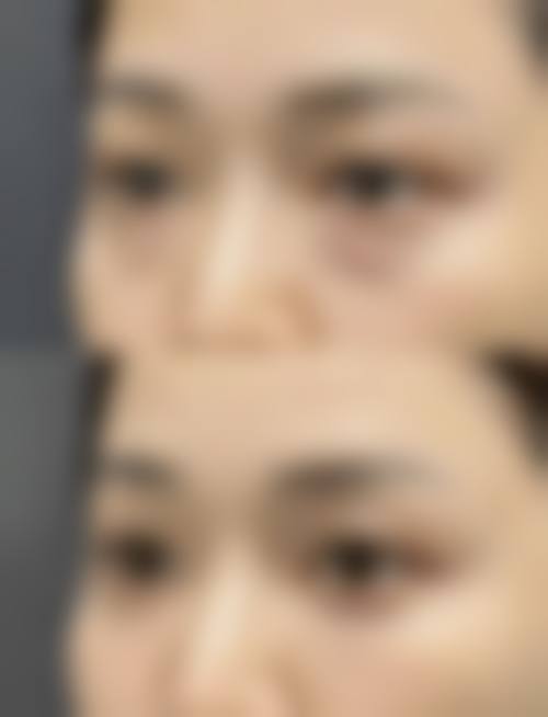 用鸡蛋滚眼睛去眼袋的综合评价与建议