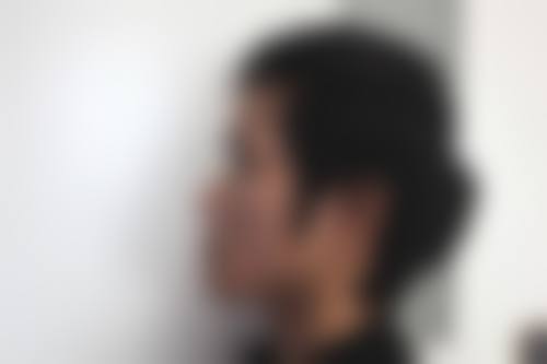 影响自体肋骨隆鼻持久性的因素