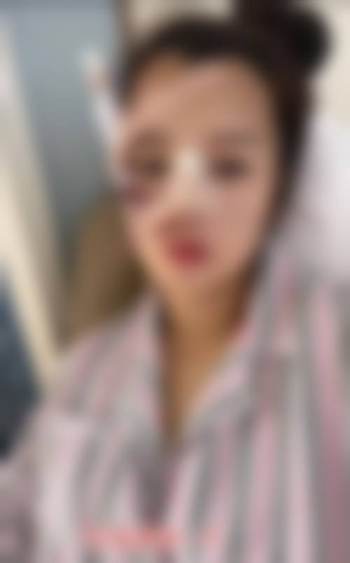 自体肋骨隆鼻的吸收与变形问题