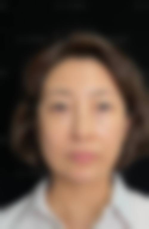六、割双眼皮项目赵鹏医生有何特色？