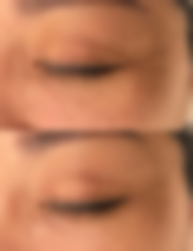{筋膜永久无痕双眼皮是怎样做的？以小切口缝合真皮与睑板筋膜，打造自然持久的无痕重睑