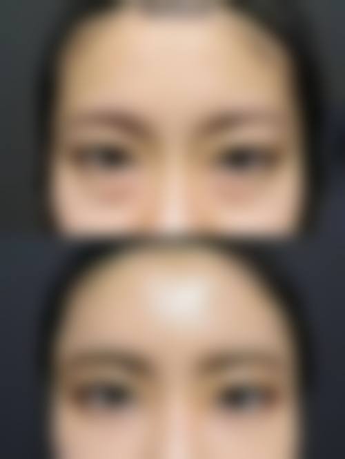 手术做眼袋维持时间与手术方式有关