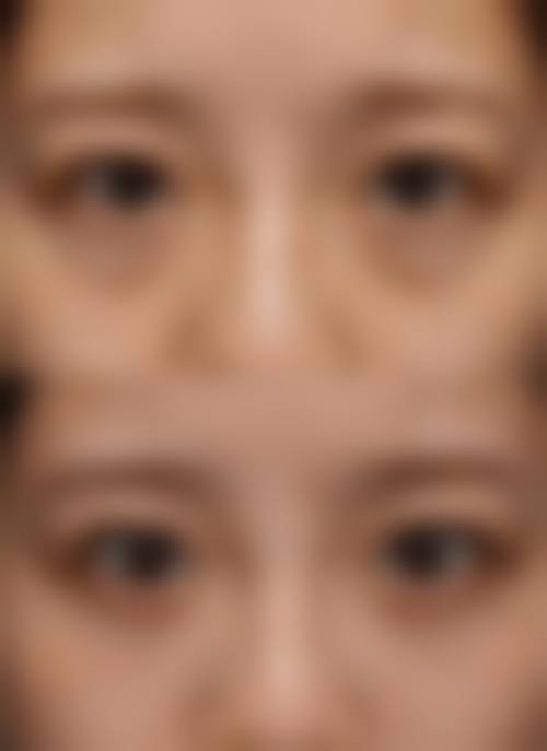 手术做眼袋维持时间受生活习惯影响
