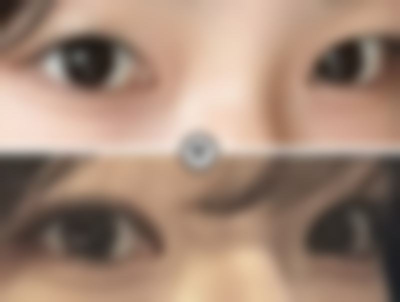 隆鼻项目特色