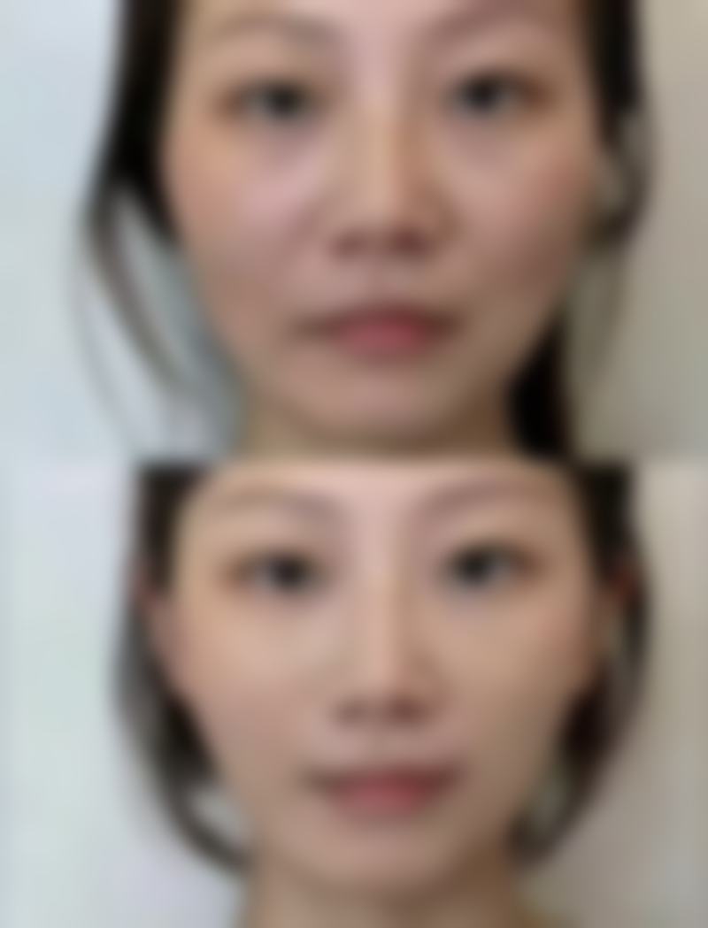 六、谢宏彬拉皮手术口碑怎么样？
