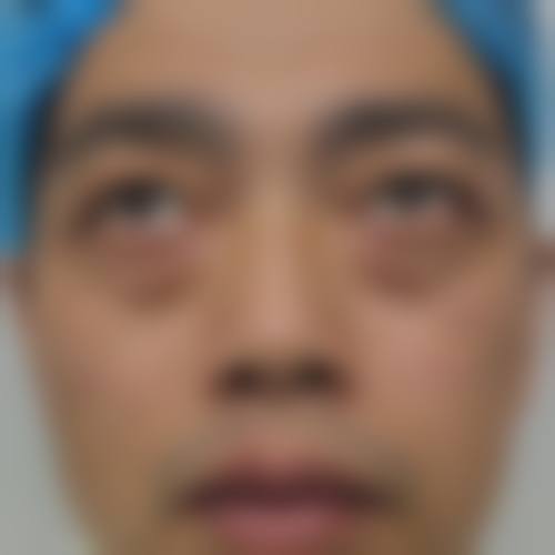 去眼袋费用：不同骨干医生不同价格