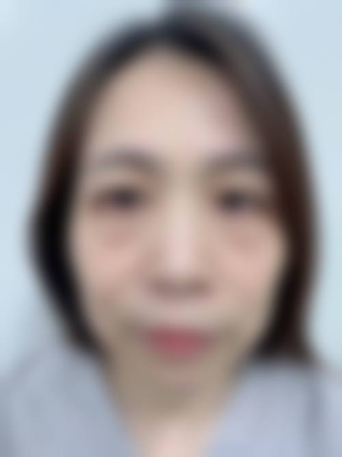 溶脂做眼袋的适用人群