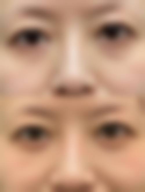 溶脂做眼袋的优势体现