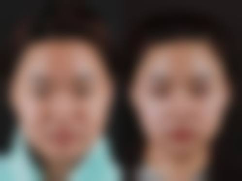 北京八大处隆鼻手术风格与审美理念
