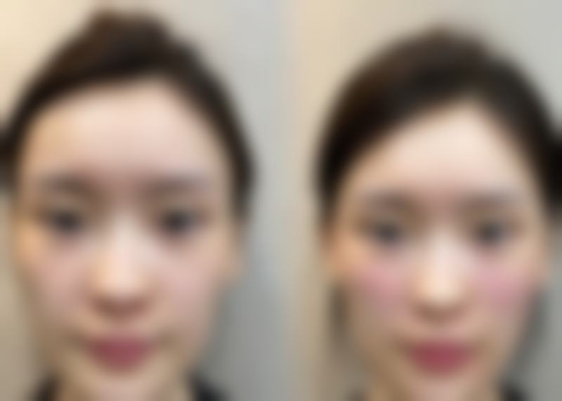 巫文云：“云梯式” 修复技术，攻克挛缩鼻难题
