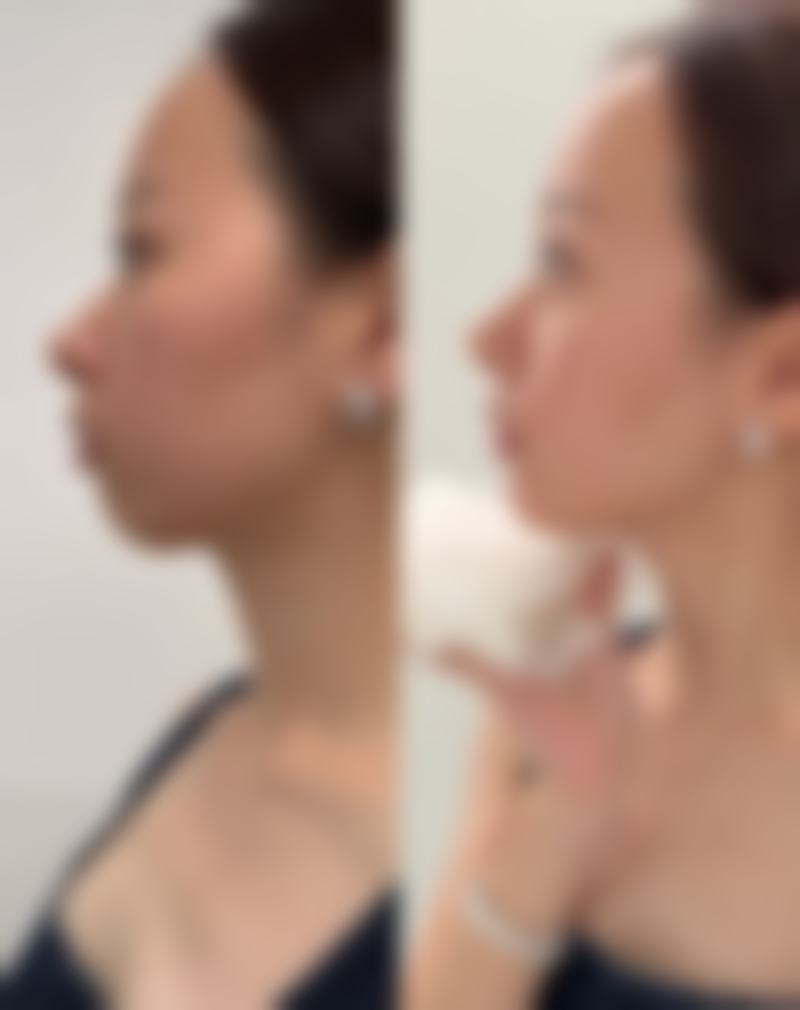 抽烟对不同类型双眼皮手术修复的影响