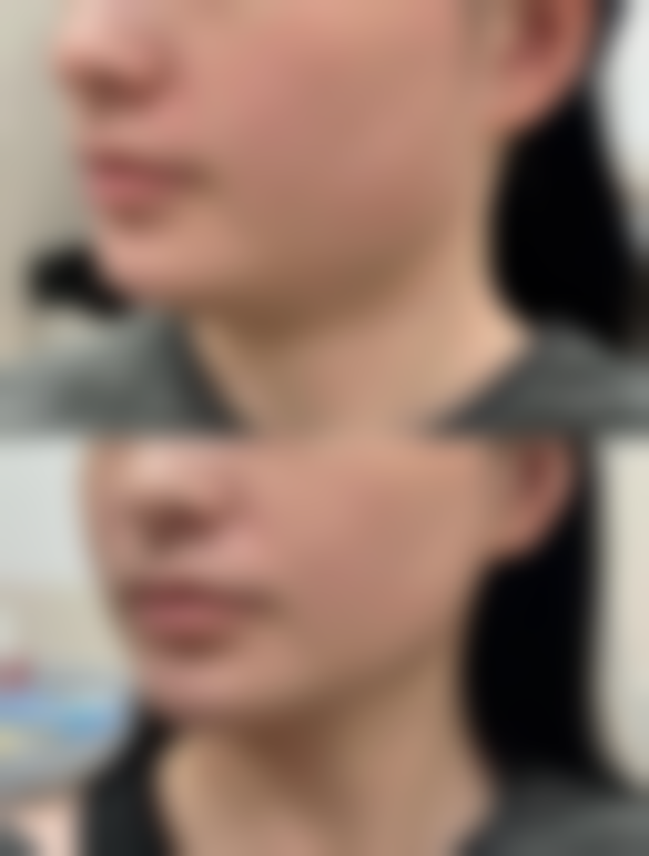 {注射隆胸有后遗症吗？——易引发感染、硬结、乳房移位，违禁材料存潜在致癌风险