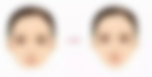 全身抽脂——皮肤紧致处理